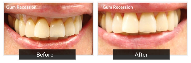 Gum Recession