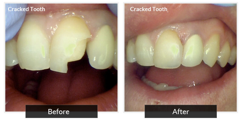 Cracked Teeth